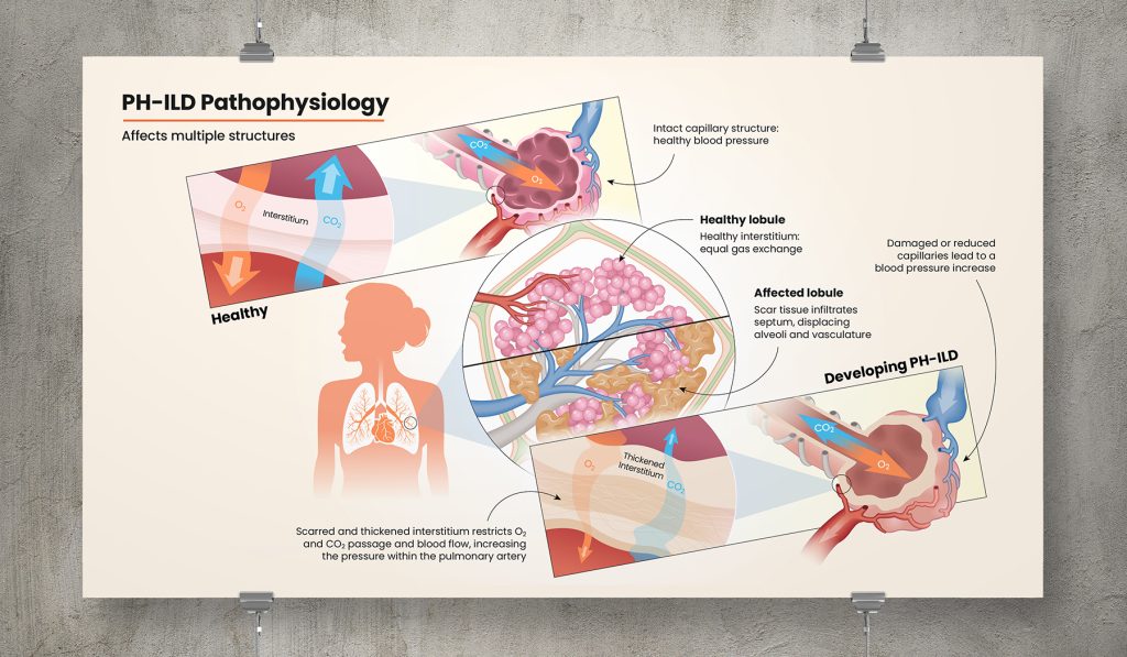 Life Science pathogenesis illustration series for United Therapeutics GMA Division