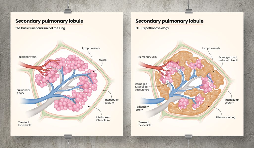 Life Science pathogenesis illustration for United Therapeutics GMA Division