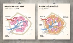 Life Science pathogenesis illustration for United Therapeutics GMA Division